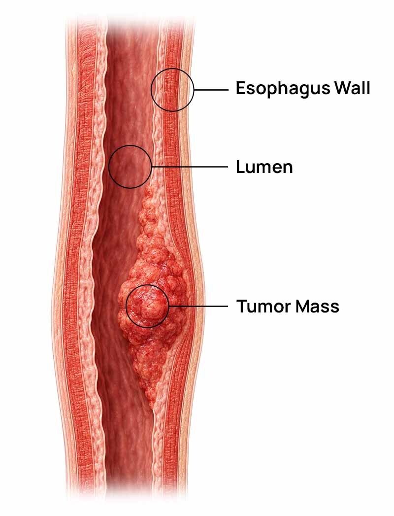 Diagram of the upper esophagus, where squamous cell carcinoma arises.